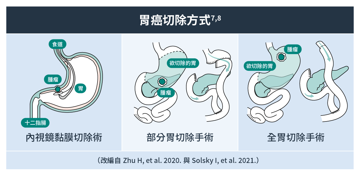 胃癌切除方式