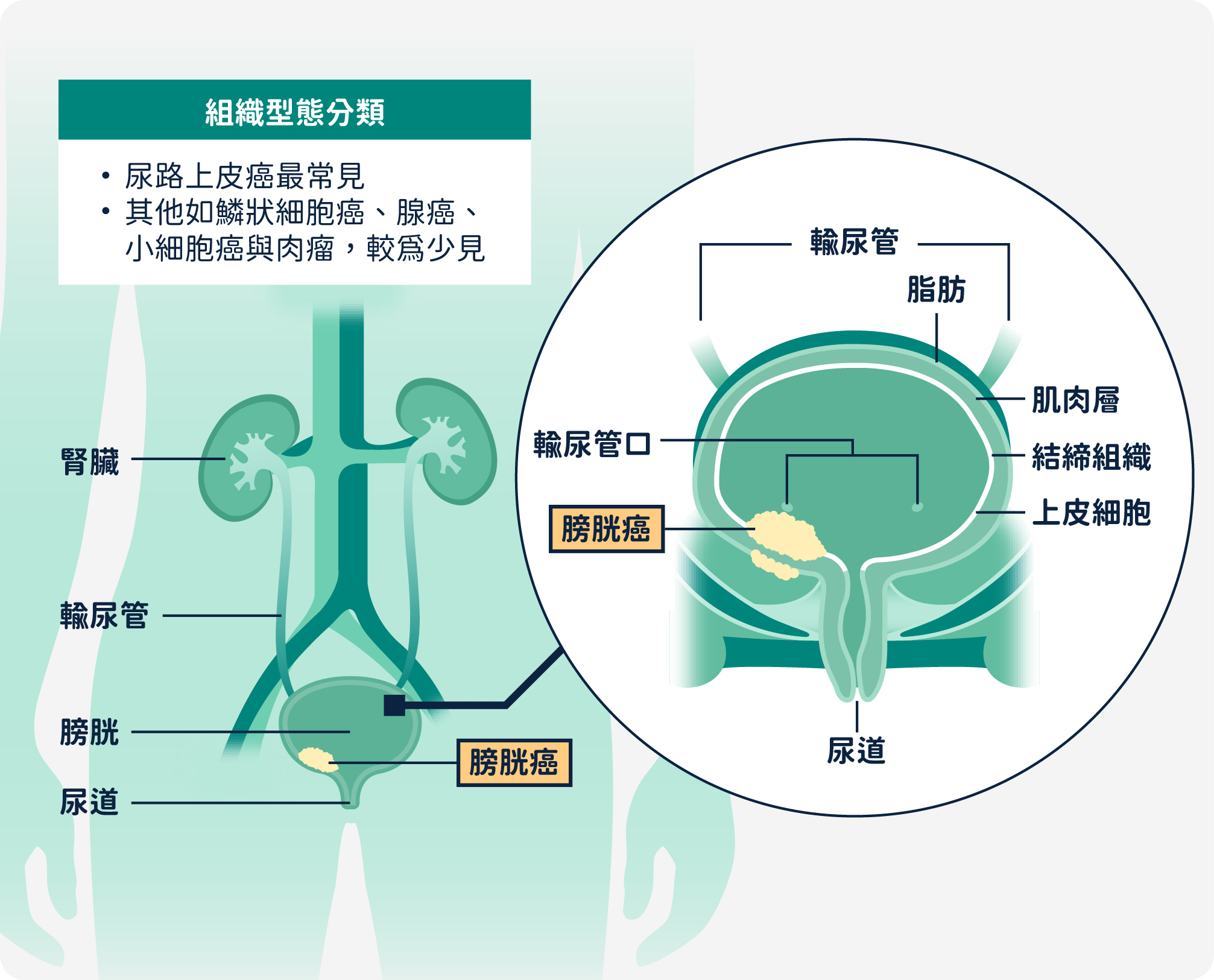 膀胱癌組織型態分類