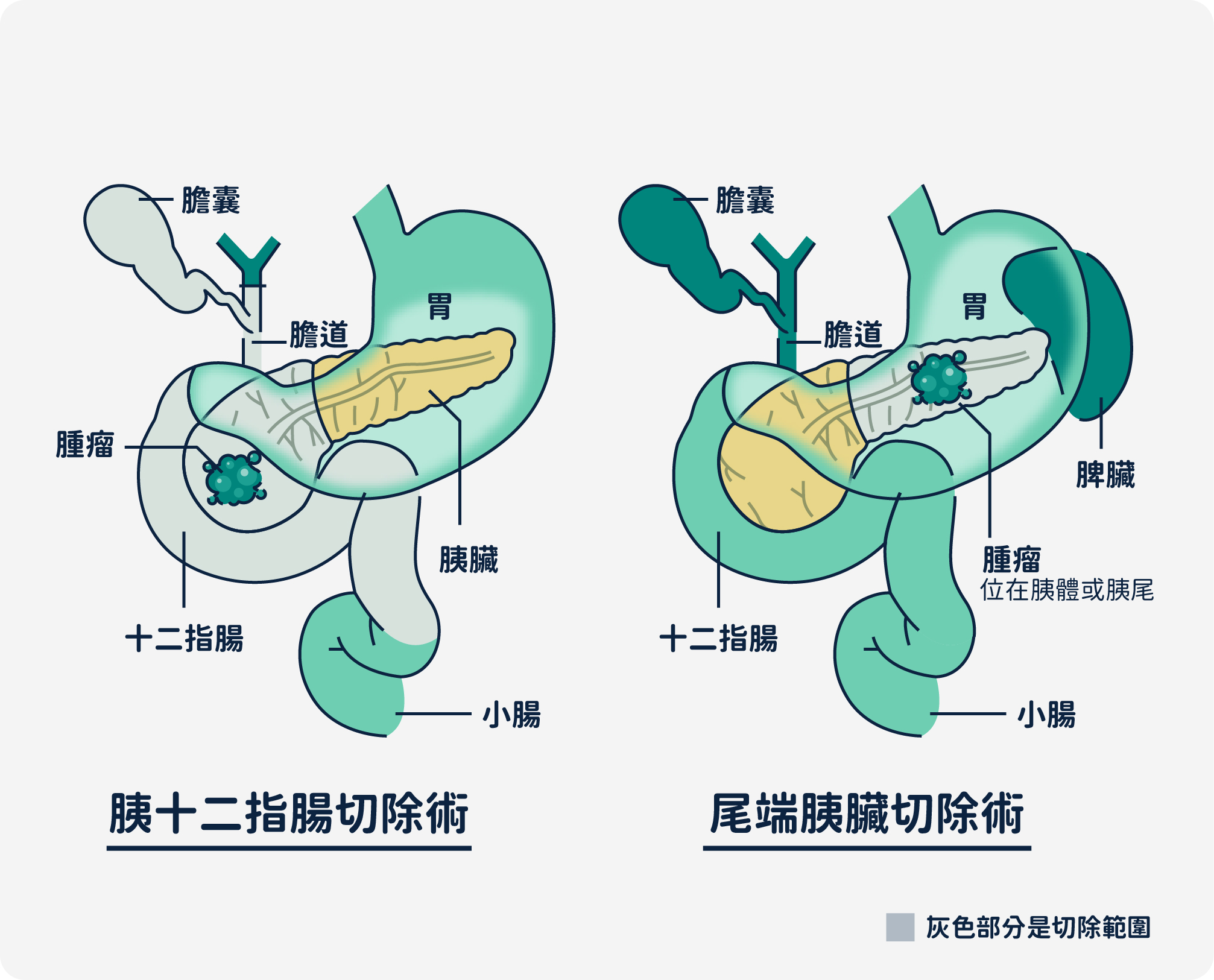 胰臟癌切除手術 - 胰十二指腸切除術以及尾端胰臟切除術