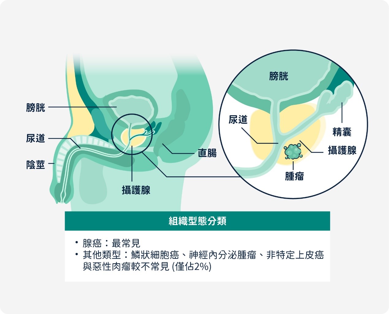 攝護腺癌組織型態分類