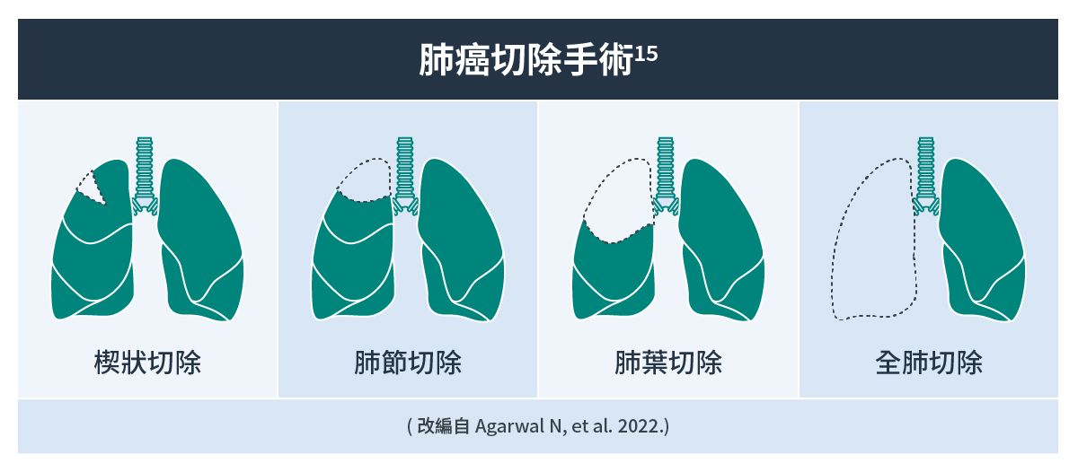 肺癌切除手術