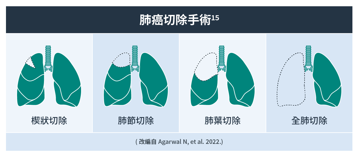 肺癌切除手術